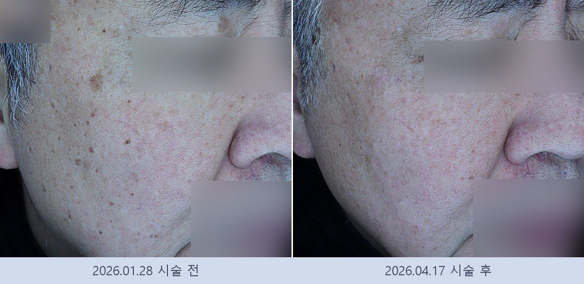 흑자 검버섯