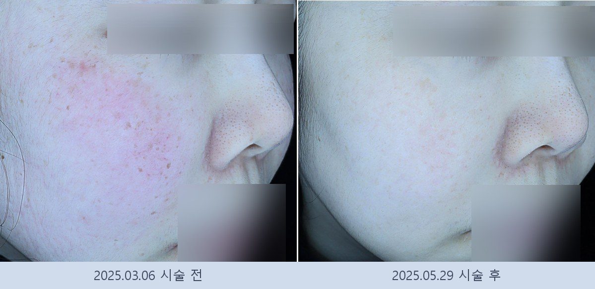 기미 잡티